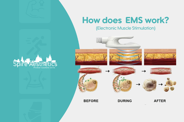 EMS treatment for post pregnancy weight loss treatment Bibury