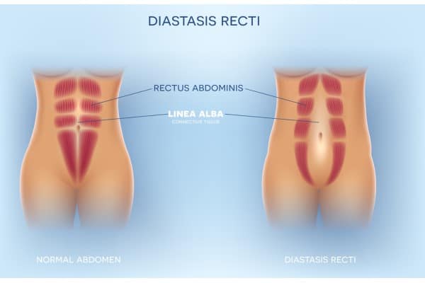 What Non-Surgical Options Are Available for Diastasis Recti Bibury?