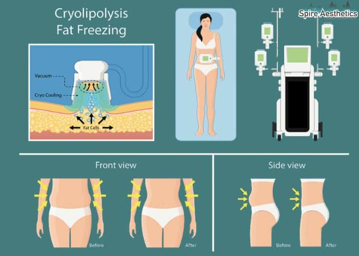 Image of diet and fat freezing combined for best results for Spire Aesthetics Bibury