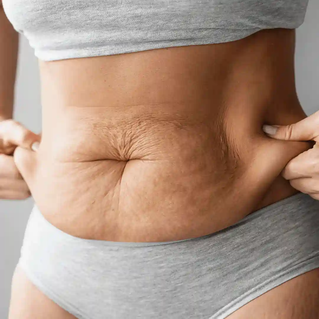 Is It Normal to Have Loose Skin After Pregnancy Bibury?